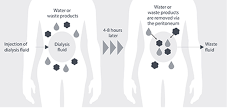 Injection of dialysis fluid / Dialysis fluid / Water or waste products / 4-8 hours later / Water or waste products are removed via the peritoneum / Waste fluid