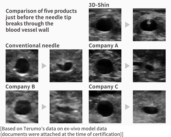 Comparison of five products just before the needle tip breaks through the blood vessel wall. / [Based on Terumo’s data on ex-vivo model data (documents were attached at the time of certification)]