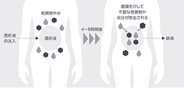 老廃物や水が透析液の注入により、4～8時間後に腹膜を介して不要な老廃物や水分が排液となり除去される