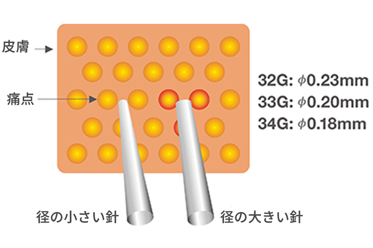 皮膚 / 痛点 / 径の小さい針 / 径の大きい針